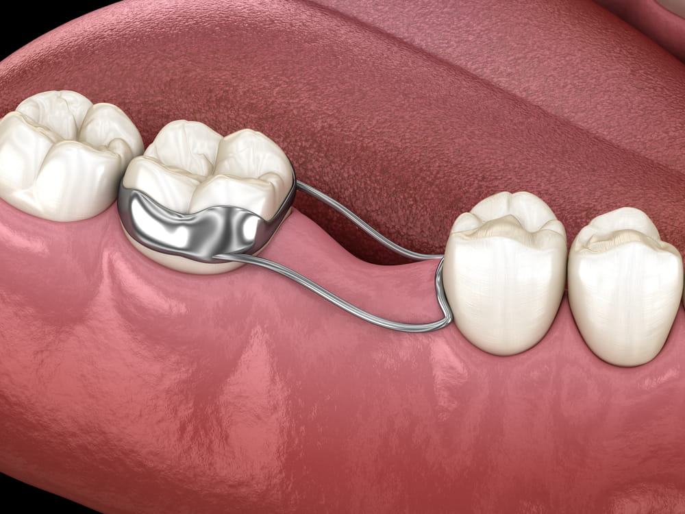 dental implants connecting tooth