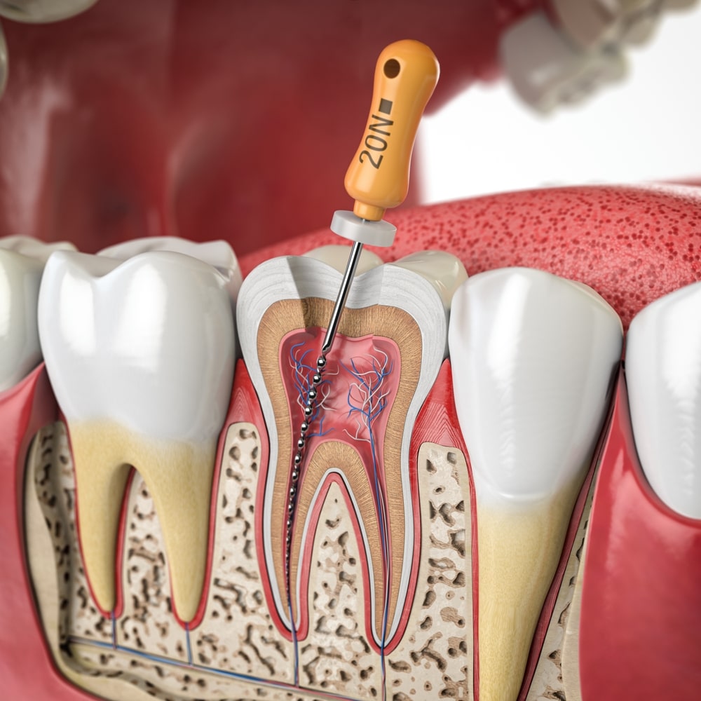 root-canal-treatment