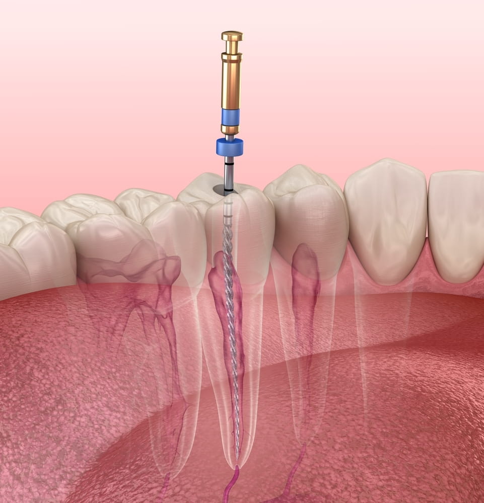 root-canal-therapy-SmileMakers