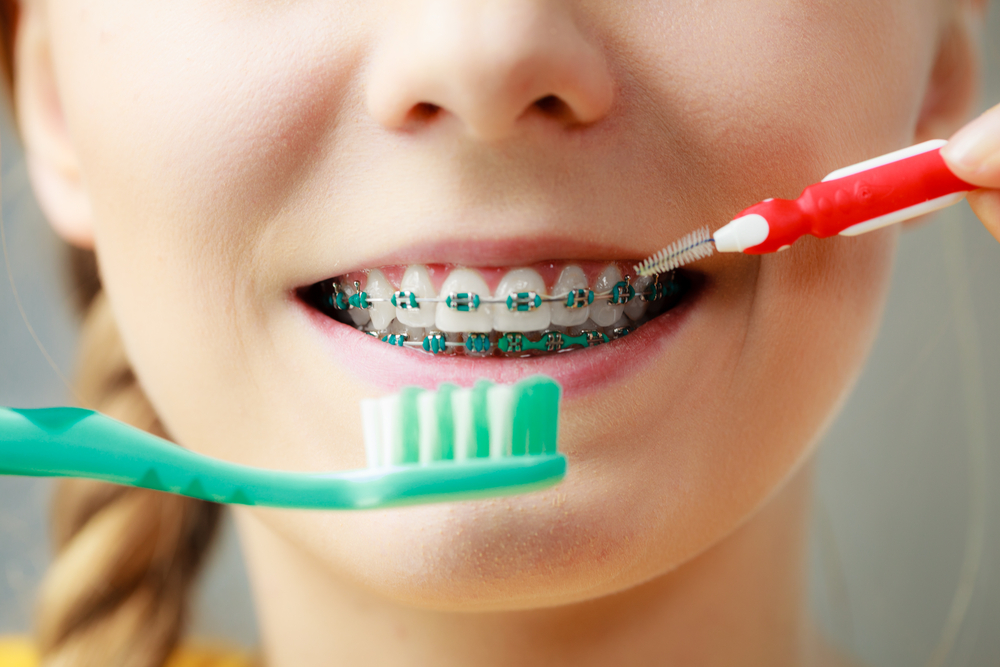 braces-interdental-teeth-brush