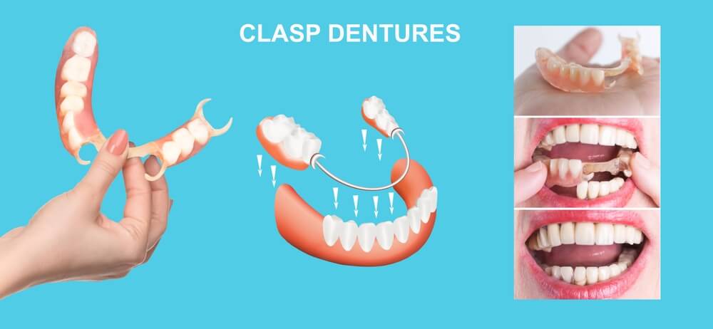CLASP DENTURE - SmileMakers