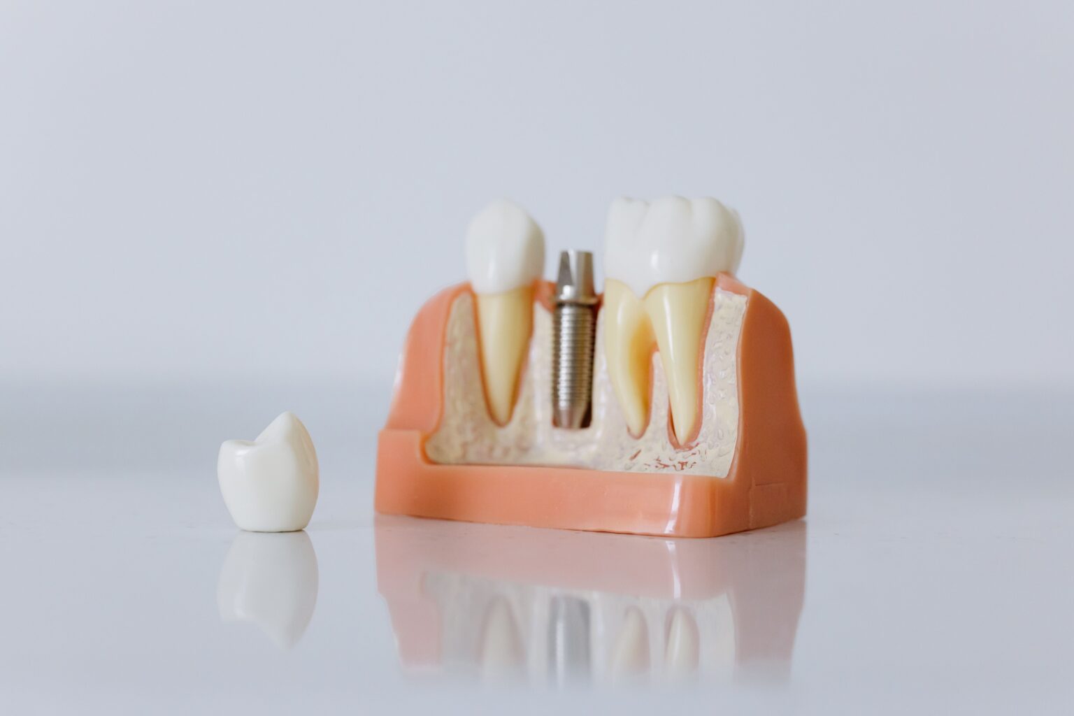dental-implants