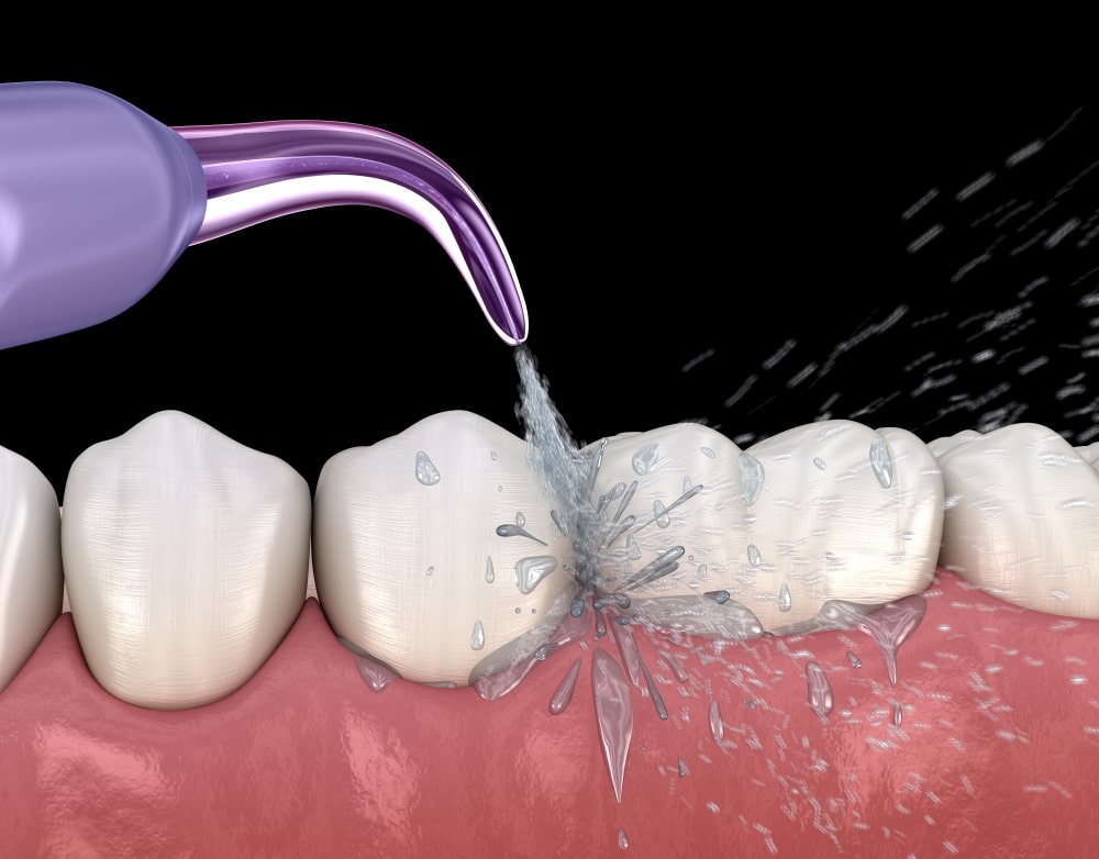 DIY-water-flosser-SmileMakers