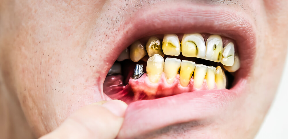 Close-up of an open mouth displaying yellowed teeth and an exposed dental implant surrounded by inflamed gums.