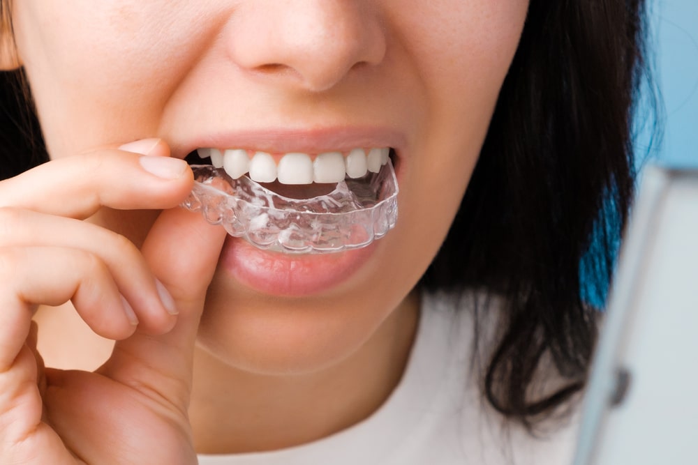 teeth-straightening-treatment