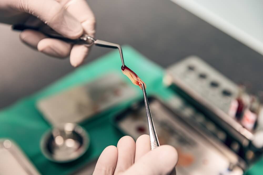 Hands in gloves hold a metal tool and a tissue sample over a surgical tray, conveying a clinical and focused atmosphere.