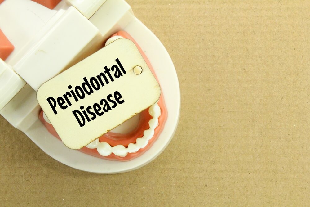 A dental model with a wooden tag reading "Periodontal Disease" placed inside, highlighting dental health concerns on a cardboard background.