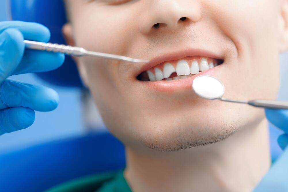 Patients Love Composite Bonding