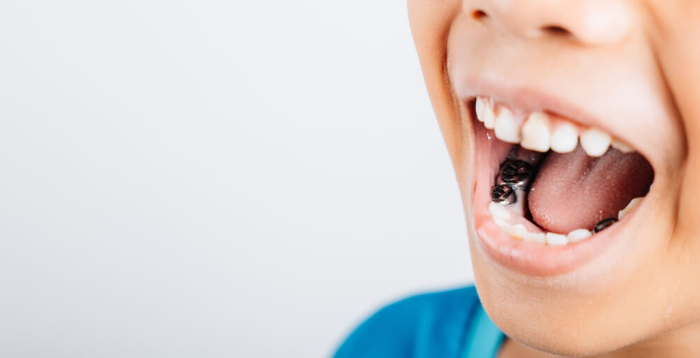 Close-up of a child’s open mouth, showcasing white teeth and a dental device inside.