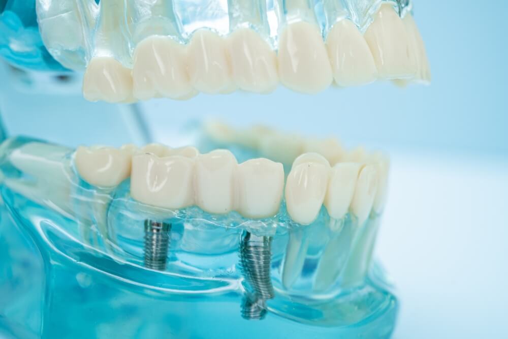 Close-up of a dental model showing a set of upper and lower teeth with dental implants. The model is transparent blue, emphasizing the implant structure.
