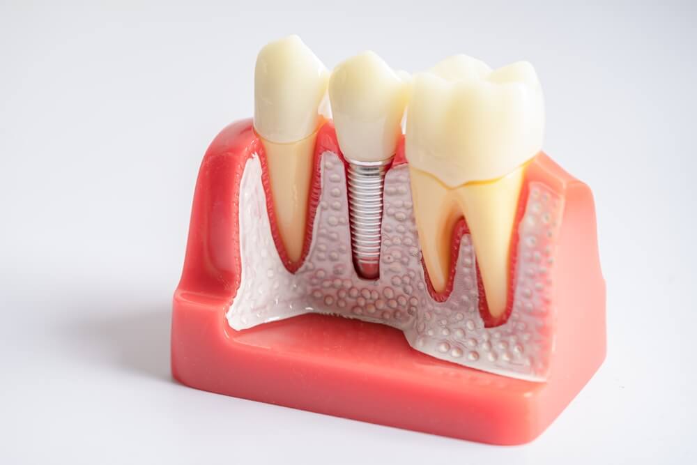 Dental model showing three teeth with a dental implant in the center. The gums are depicted in red, and teeth roots are visible, illustrating oral anatomy.