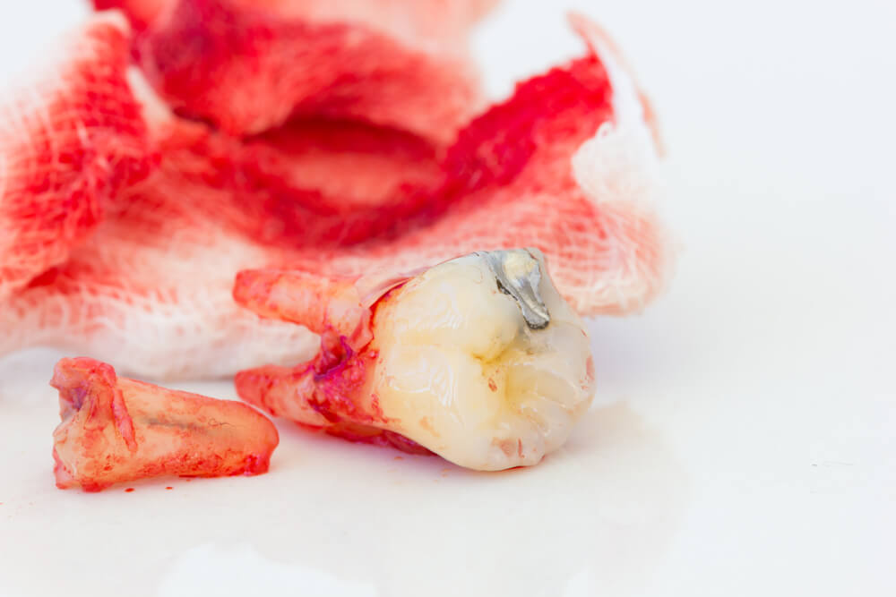 A close-up of a tooth with a piece of red tissue attached, illustrating a dental injury.
