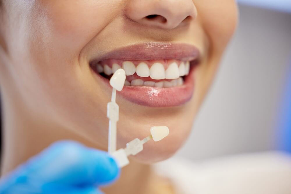 A smiling woman proudly displaying her bright smile, likely enhanced with porcelain veneers.