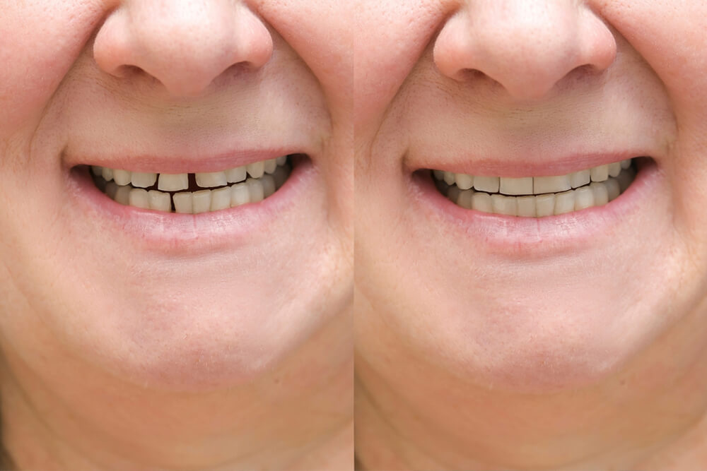 Before and after teeth whitening, showcasing the results of the Space Maintainer process.