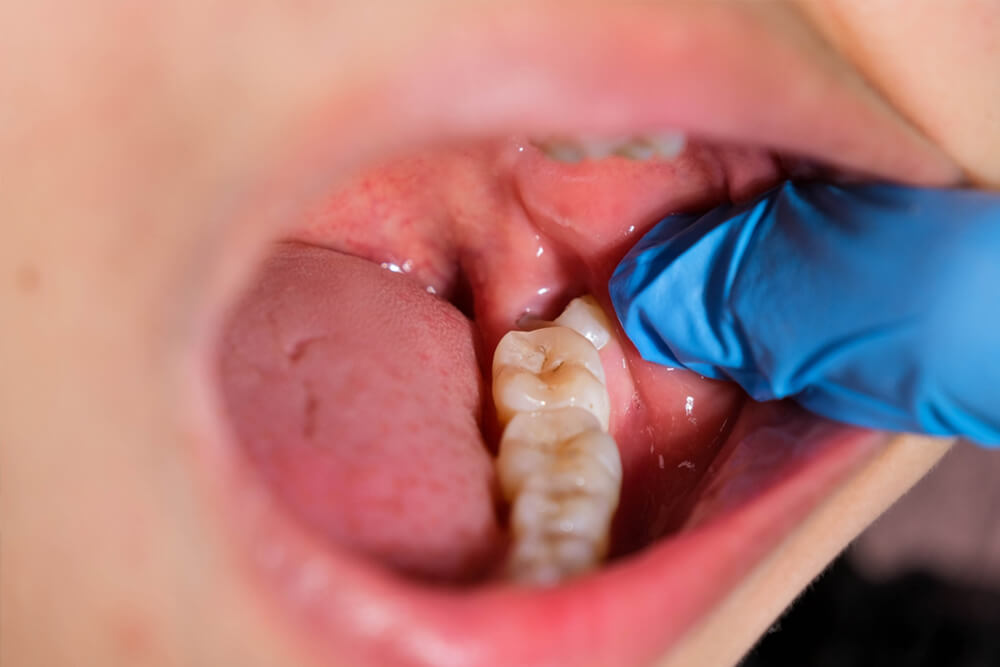 Focusing on wisdom teeth care.