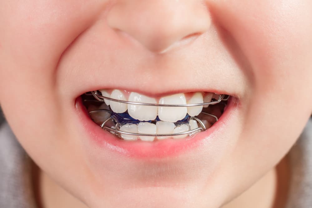 orthodontic-evaluation-children