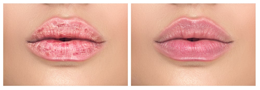 dry-mouth