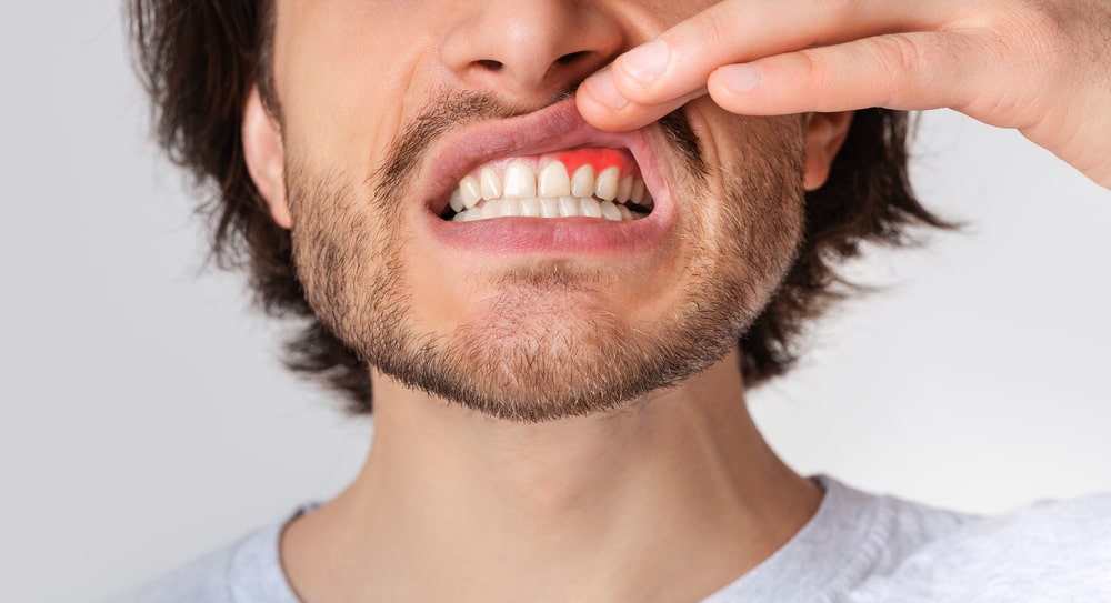early-gum-disease-brampton