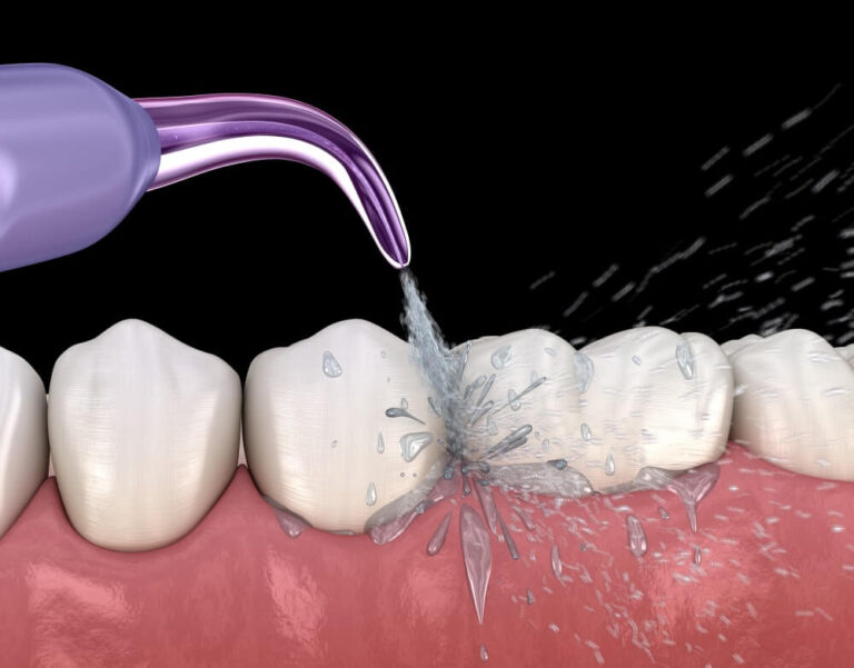DIY-water-flosser-SmileMakers