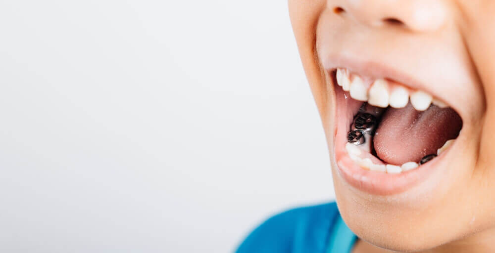 Close-up of a child’s open mouth, showcasing white teeth and a dental device inside.