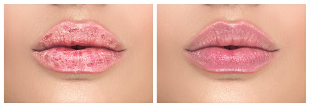dry-mouth