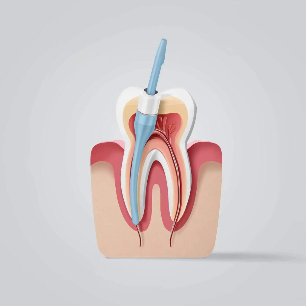 Root Canal Therapy