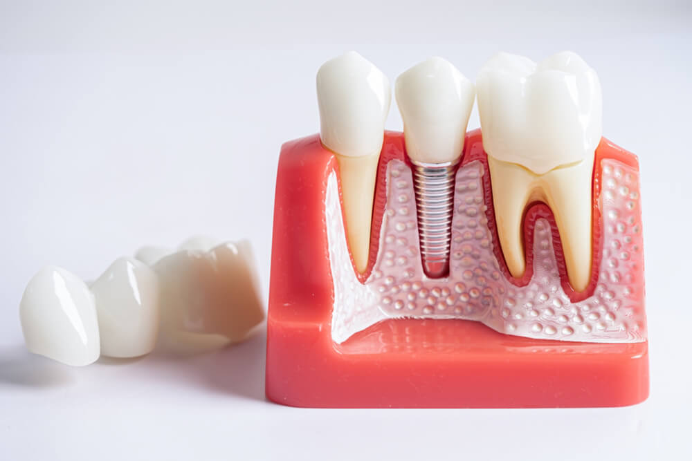 Model of a tooth featuring a dental implant, illustrating the root canal procedure and its components.
