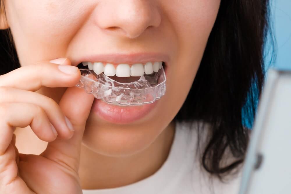 Teeth-straightening-treatment